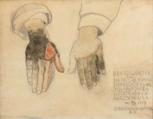 Josef Heu, „Brandwunden und Metall- u. Russimprägnierung der Haut durch elektrischen Kurzschluss am 21.V.1917. Garnisons-Spital Nr. 2.“, 1917